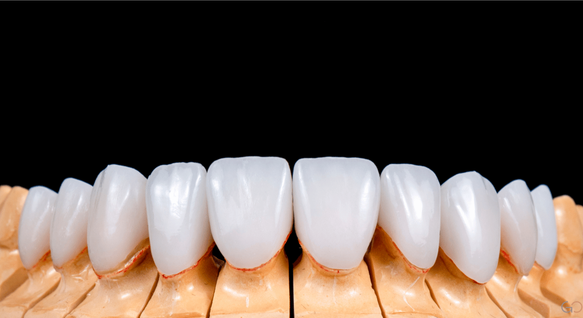 Lee más sobre el artículo Carillas de porcelana: Tipos, precios y tratamientos