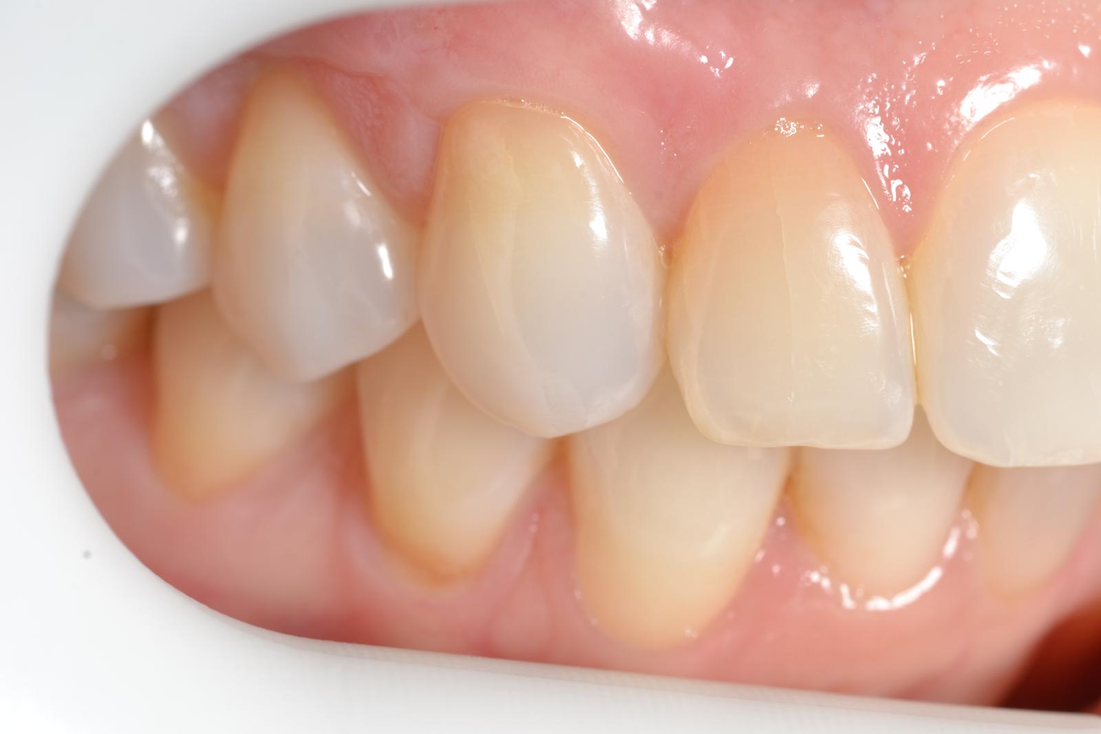 Lee más sobre el artículo Antes y Después Tratamiento de Periodoncia
