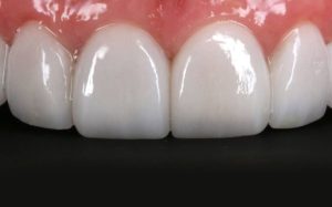 Lee más sobre el artículo Cómo es el mantenimiento de las carillas dentales