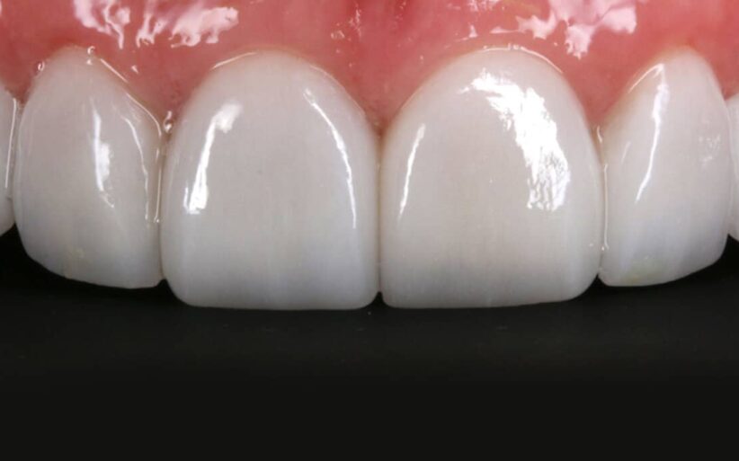 Lee más sobre el artículo Cómo es el mantenimiento de las carillas dentales