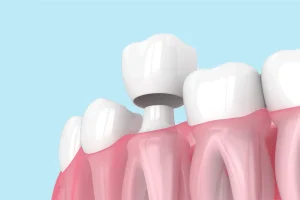 Lee más sobre el artículo Corona Dental: Tipos, precios y tratamientos
