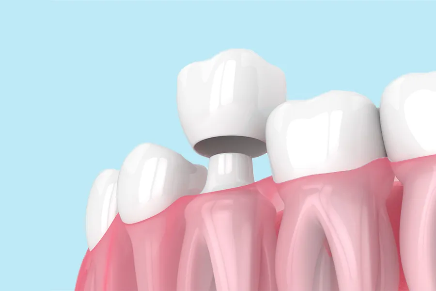 Lee más sobre el artículo Corona Dental: Tipos, precios y tratamientos