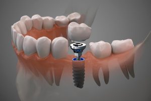 Lee más sobre el artículo Beneficios de los implantes dentales