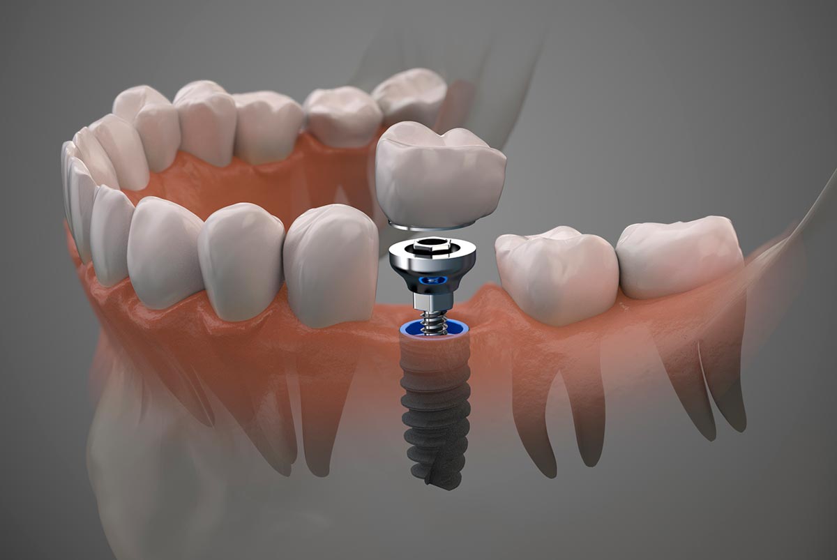 Lee más sobre el artículo Beneficios de los implantes dentales
