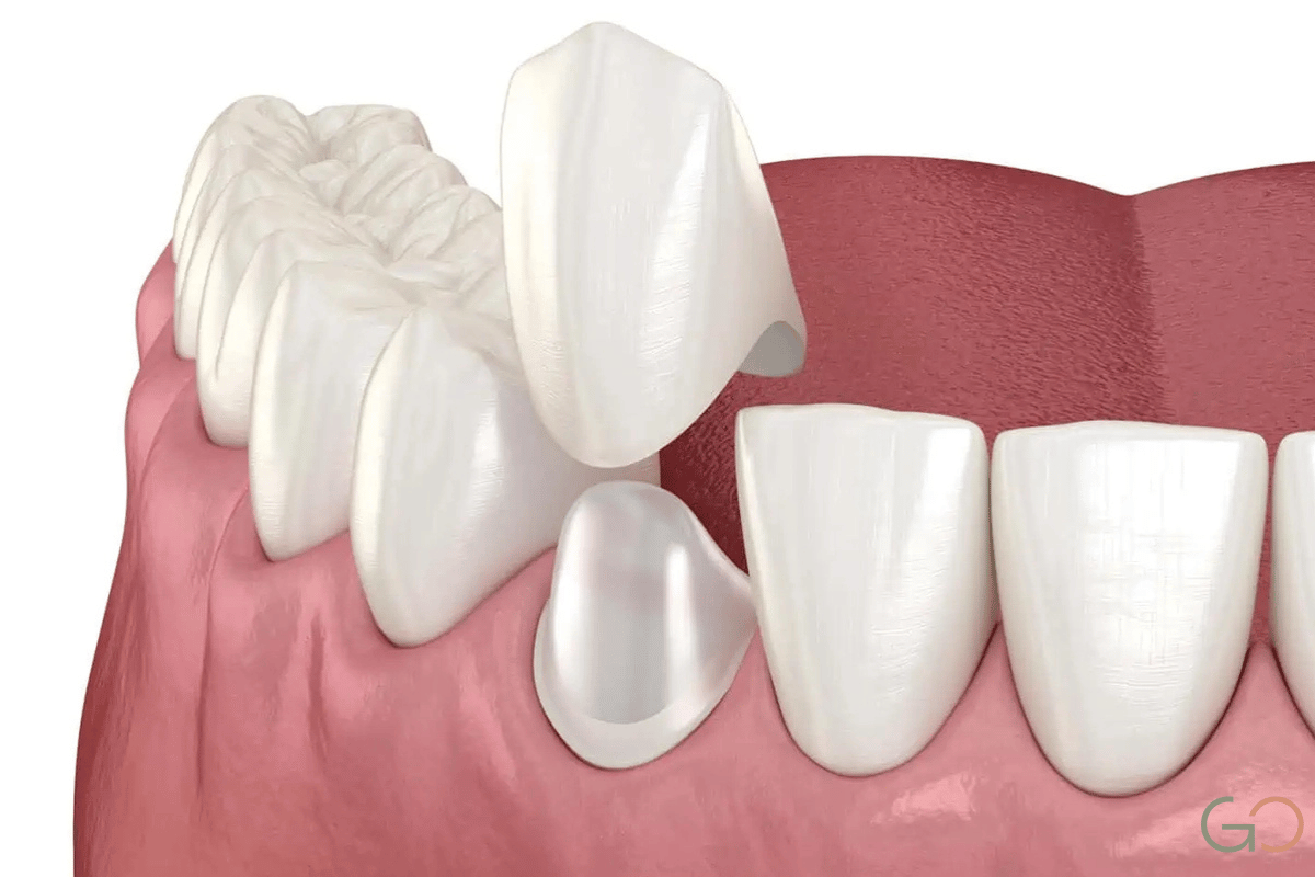 En este momento estás viendo ¿Qué hacer si se cae una corona dental? Guía de primeros auxilios dentales