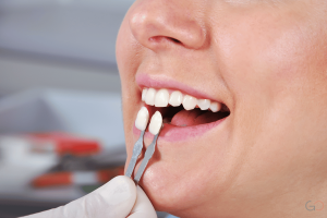 Lee más sobre el artículo Coronas dentales estéticas para el sector anterior (dientes frontales)