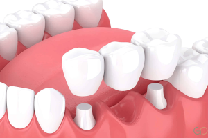 Lee más sobre el artículo Puentes dentales vs implantes: ventajas y desventajas en rehabilitación