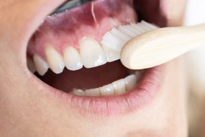 Recuperación después de una Gingivectomía