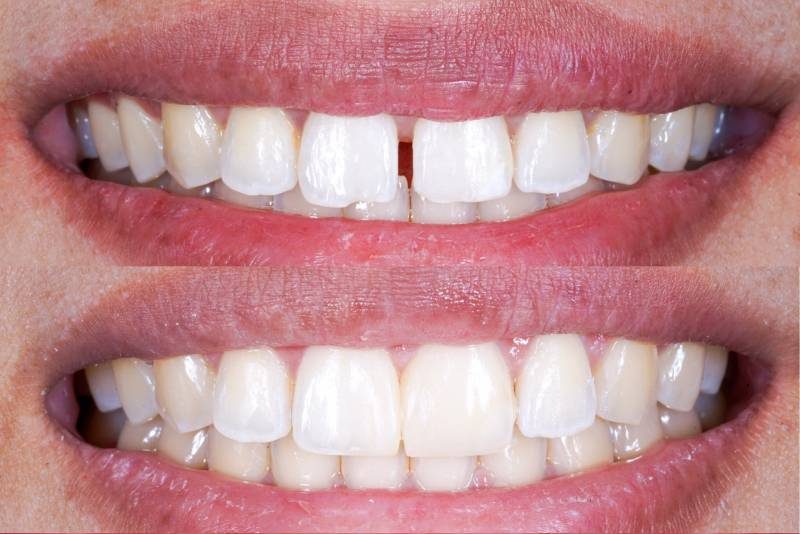 Lee más sobre el artículo Dientes separados: opciones de tratamiento según edad y causa