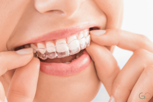 Lee más sobre el artículo Brackets o alineadores invisibles: cuál conviene según cada caso
