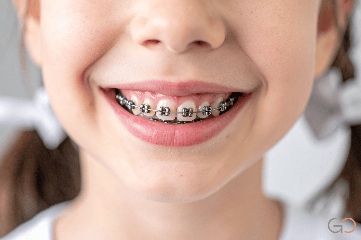 Lee más sobre el artículo Brackets: tipos, precios y diferencias entre metálicos, estéticos y autoligados