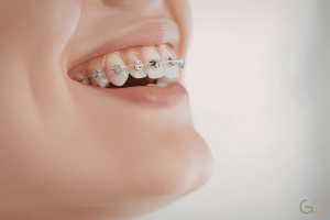 Lee más sobre el artículo Ortodoncia y dolor: qué es normal y cómo aliviar las molestias