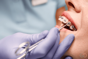 Lee más sobre el artículo ¿Cuánto dura un tratamiento de ortodoncia y de qué depende realmente?