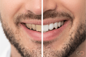 Lee más sobre el artículo Alimentos y hábitos que arruinan tu blanqueamiento dental