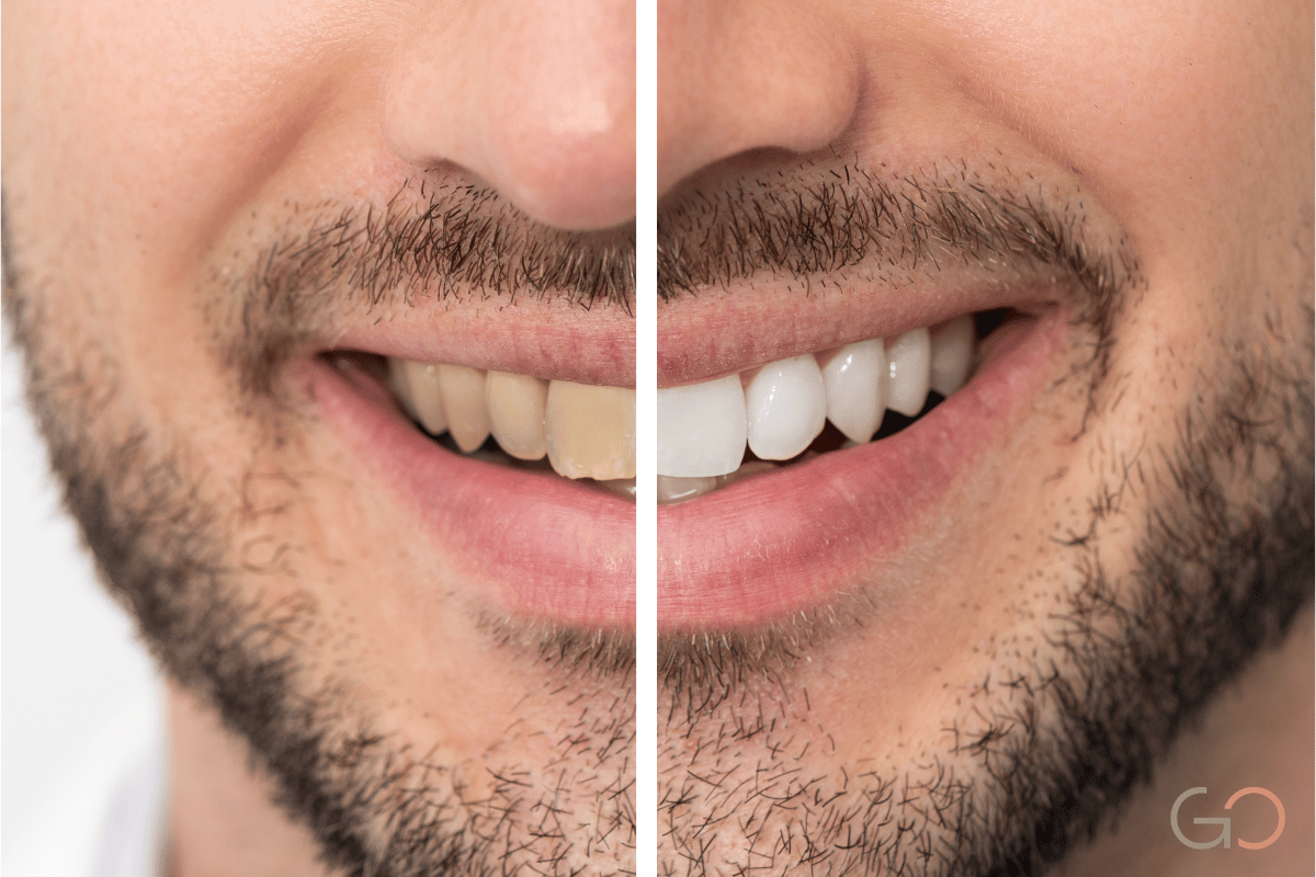 En este momento estás viendo Alimentos y hábitos que arruinan tu blanqueamiento dental