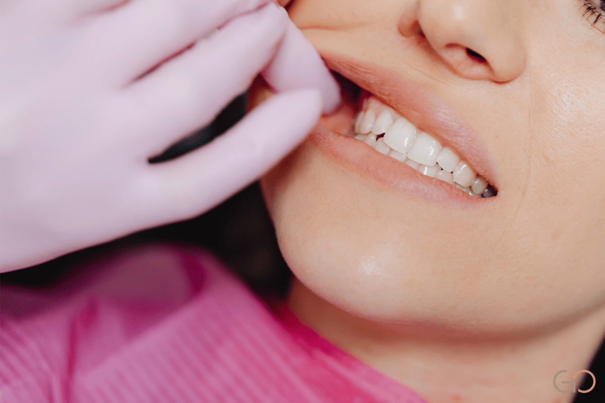En este momento estás viendo Desgaste dental por ácido (erosión): cómo se reconstruye la sonrisa