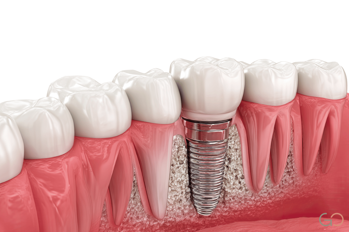 En este momento estás viendo ¿Duele colocarse un implante dental? Qué esperar realmente