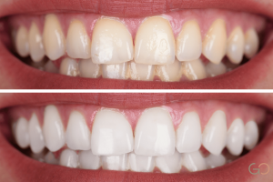 Lee más sobre el artículo ¿Se pueden blanquear dientes con carillas o coronas?