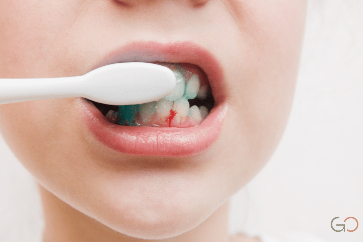 En este momento estás viendo Periodontitis agresiva en personas jóvenes: por qué aparece y cómo se trata