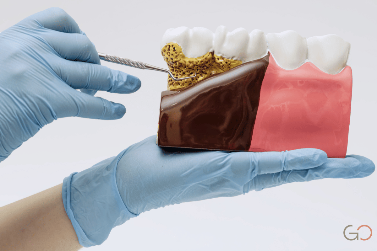 En este momento estás viendo Tabaquismo y encías: cómo el cigarrillo enmascara y agrava la periodontitis