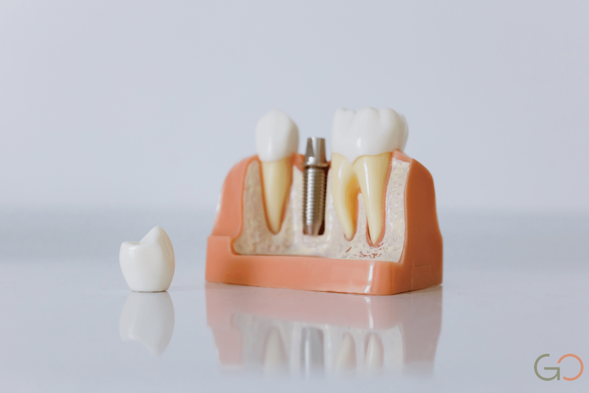 En este momento estás viendo Zirconio, disilicato de litio o metal-porcelana: qué material elegir