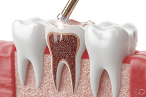 endodoncia en Montevideo