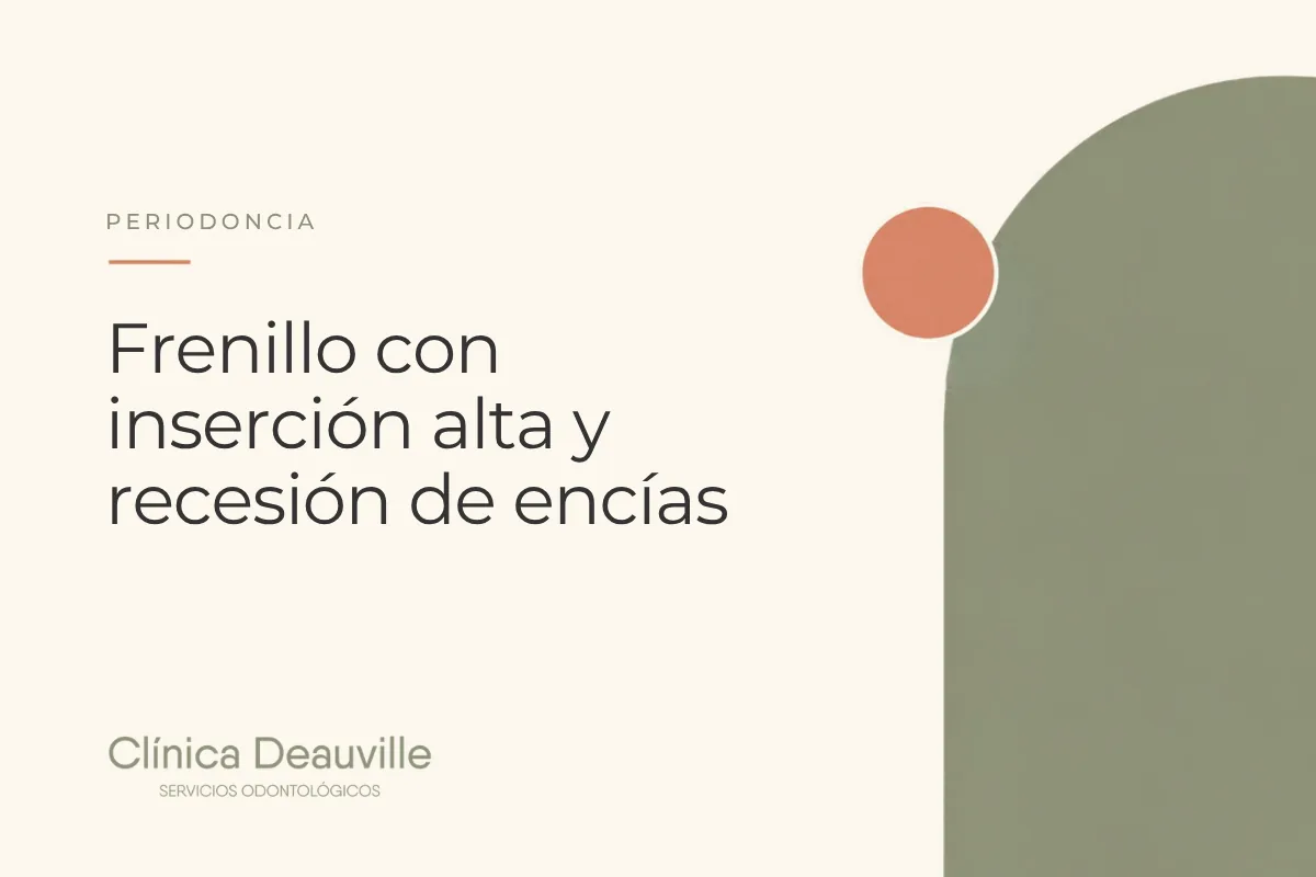 En este momento estás viendo Frenillo con inserción alta y recesión de encías: cuándo el frenillo tira de la encía