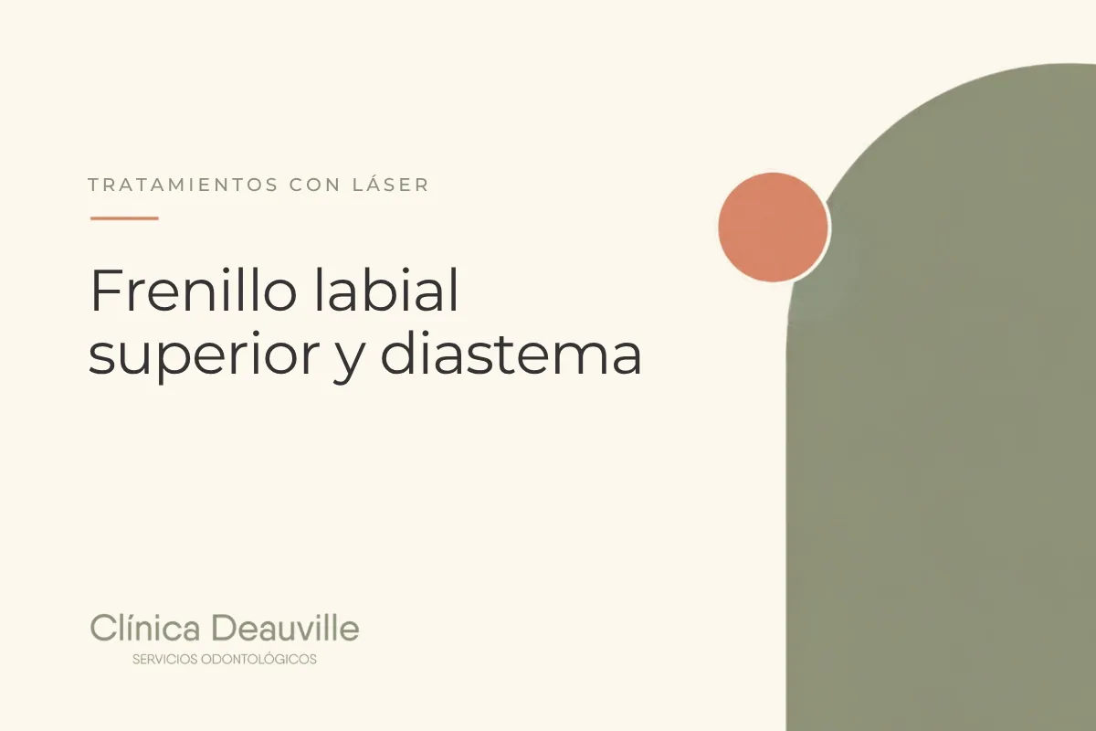 En este momento estás viendo Frenillo labial superior y diastema: ¿cortar antes o después de la ortodoncia?