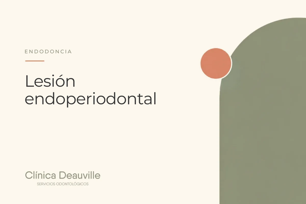 En este momento estás viendo Lesión endoperiodontal: cuando la infección del conducto y la de la encía se combinan