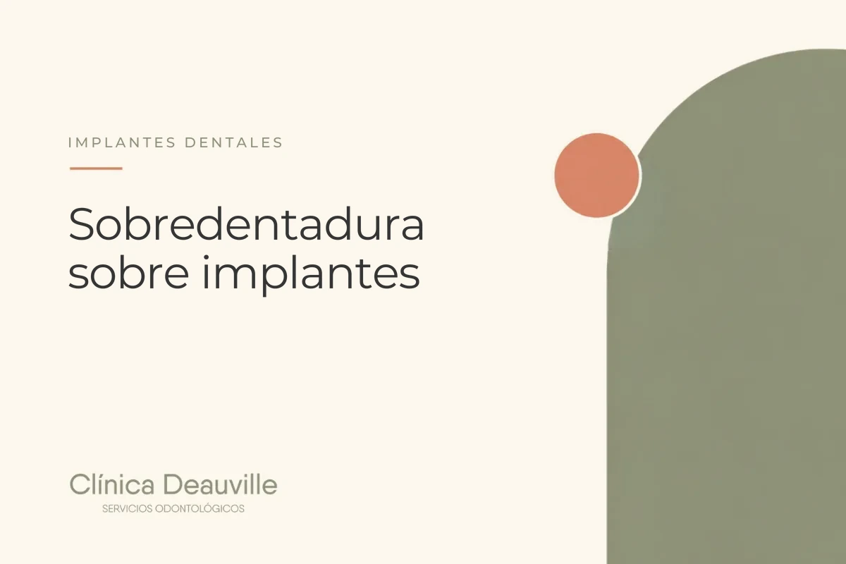 En este momento estás viendo Sobredentadura sobre implantes: la alternativa fija y estable a la dentadura completa